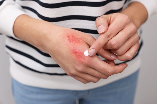 Creme e Spray per Lenire le Scottature